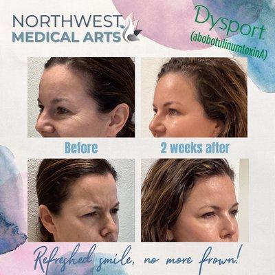 Before and after Dysport treatment