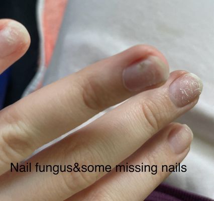 Damaged nails and fungus from ANC popped off 6 nails total. never seen anc pop off clean like this? Train or Bad product?