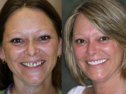 before and after smile makeover