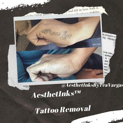 Non-Láser Tattoo removal before and after. Only one session.