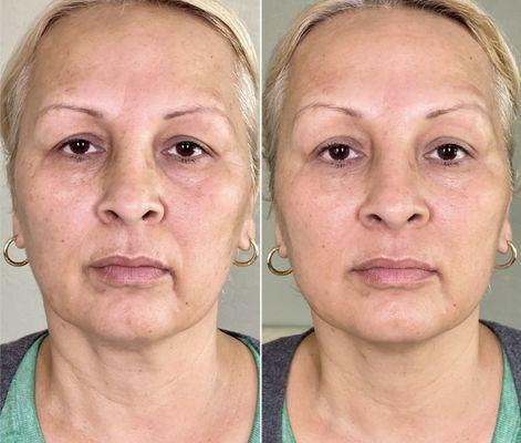 Before and After 3 (once a week) Full-Face and Upper Neck area Jet Plasma Treatments.