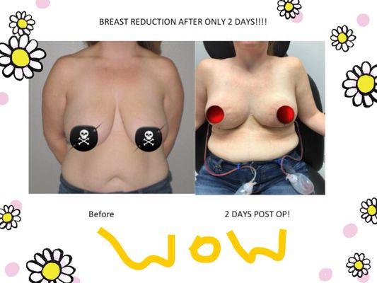 Before and after breast reduction