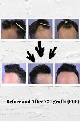 Before and after hair transplant results with Dr. Nicole Rogers