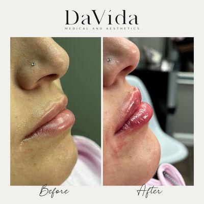 Before and after of lip filler done at premium medical spa in San Antonio - Davida Medical and Aesthetics