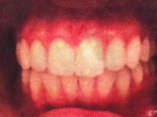 AFTER: No gap! Ignore the "grooves" on my teeth, I accidentally spilled water on the photo.