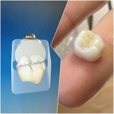 Dr Jonathan Backer's work. From computer mock-up to finished crown and in my mouth in under an hour