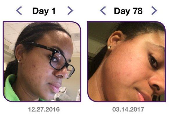 Pre visiting Clynically Clear (day one) and and after ~3mo (day 78). Pictures are worth a million words! Cheers for clear skin.