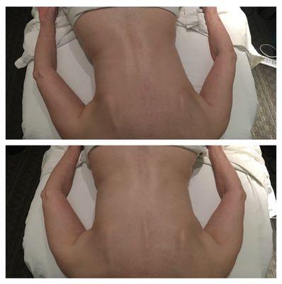 Scoliosis top pic : Before - bottom pic : After 1 session