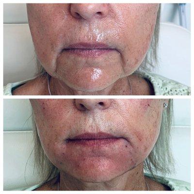 Liquid face lift with Voluma filler!