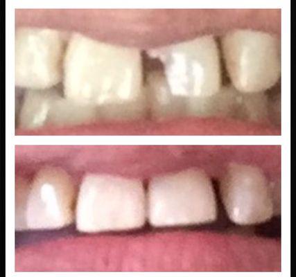 Before and after pictures of the repair of my broken tooth.