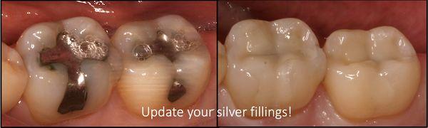 Tired of silver fillings? Call us to find out about replacing your silver fillings with tooth colored ones!