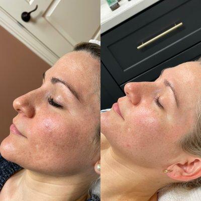 Custom skin care regimen, chemical peels and micro needling helped us transform our gorgeous clients skin. These were results after 6 months