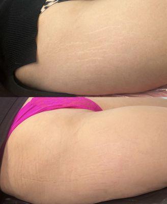 Inkless Stretch Mark Rejuvenation - After 1 Session