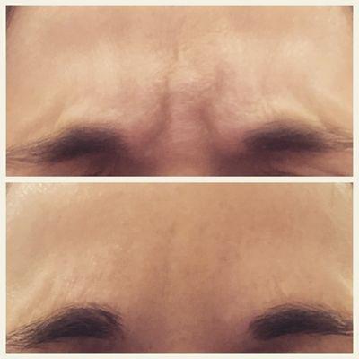 Treatment of the Glabellar Complex or Frown Lines with Botox