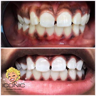 Get the fresh, healthy looking smile you can't wait to floss with a teeth whitening session at Iconic Smile Studio.