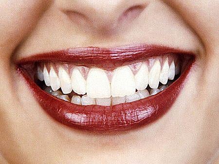 Bright white smile in 15-20 minutes!