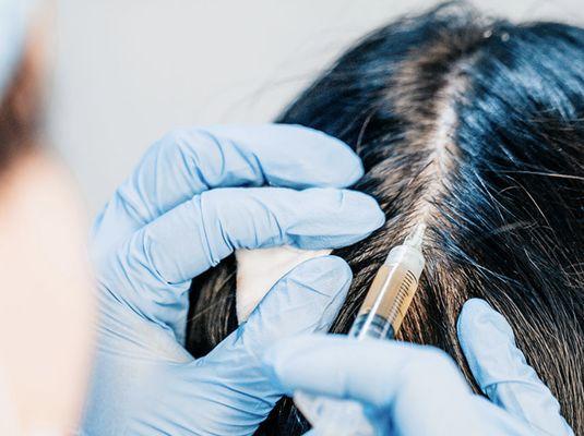 PRP Hair Restoration