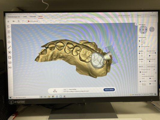 Brand new digital scanner for same-day crowns, bridges, implants and clear aligners! No more "goop" impressions!!