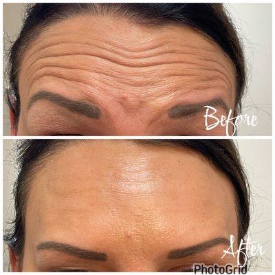 Xeomin to smooth and soften lines and wrinkles and n the forehead