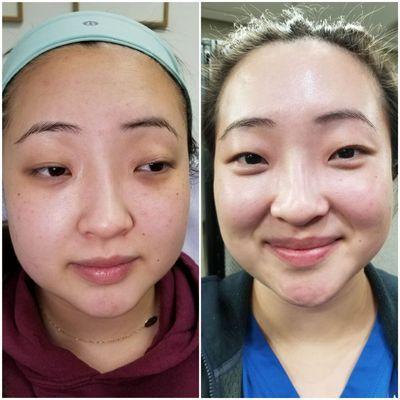 This client had a ViPeel. Chemical peels help with
-Fine lines
-Melasma
-Even out skin tone