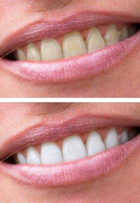 Teeth Whitening