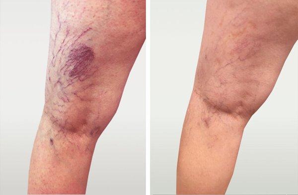 Spider veins before and after treatment