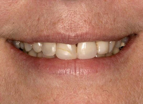 A patient's smile before our smile design .