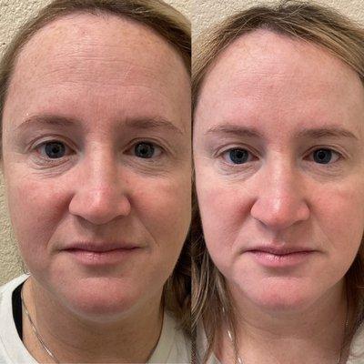 Upper face Botox treatment