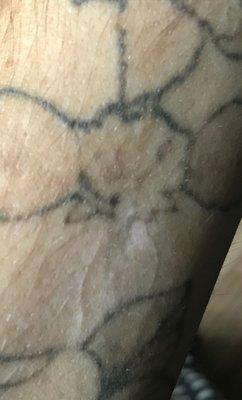 Hypo-pigmented scar from being burned from Belle Mia's laser. They deny burning my skin and blame me. Horrible customer service.