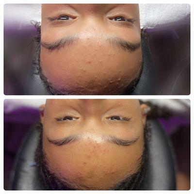 Before and after teen facial