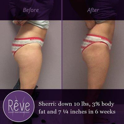 Weight loss before and after photo at Rêve Body Sculpting