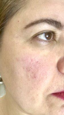 Before there is acne scars blackheads inflamed and dark circles.