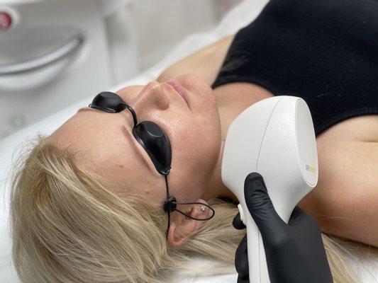 IPL photofacial