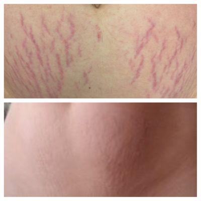 Stretch Mark reduction. Photo just after 3 treatments!