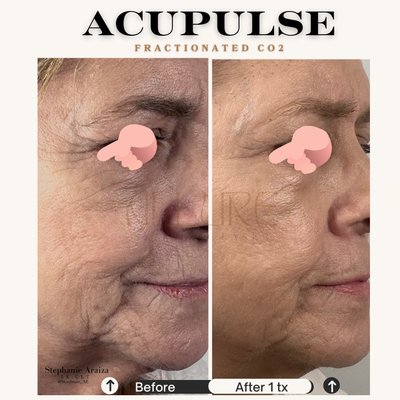 Lumenis Acupulse Co2 Laser Full Face treatment.