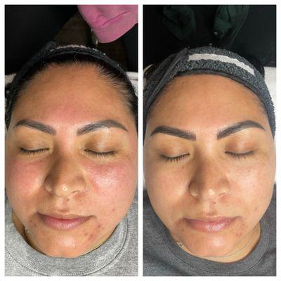 Acne / rosacea facial