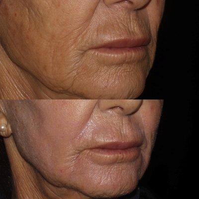 C02 Fractional skin resurfacing laser helps smooth and resurface texture irregularities and wrinkles.