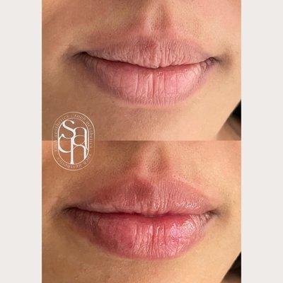 Hydrating and sharpening borders of lips on this South Asian patient with 1 syringe of filler.