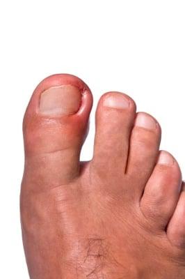 Podiatrist, Fungal Nail Treatment, Ingrown Toenails, Heel Paim, Orthotics