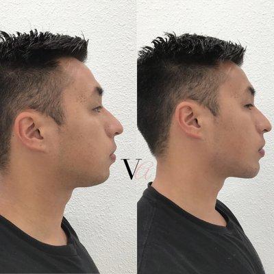 Chin and Jawline Filler Augmentation