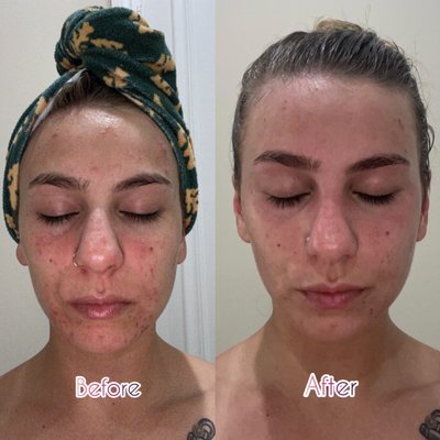 Before and after DermaSwiss chemical peel