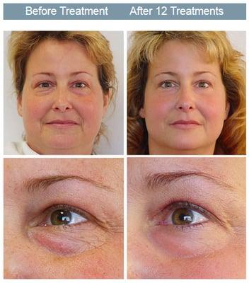 A non-invasive and comfortable alternative to facial surgery, botox, thermage, dermabrasion, and chemical peels.