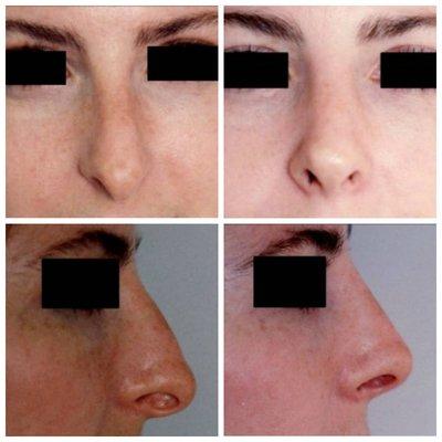 Rhinoplasty