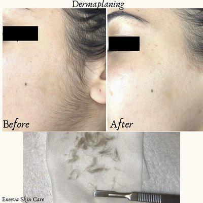 Dermaplaning Facial