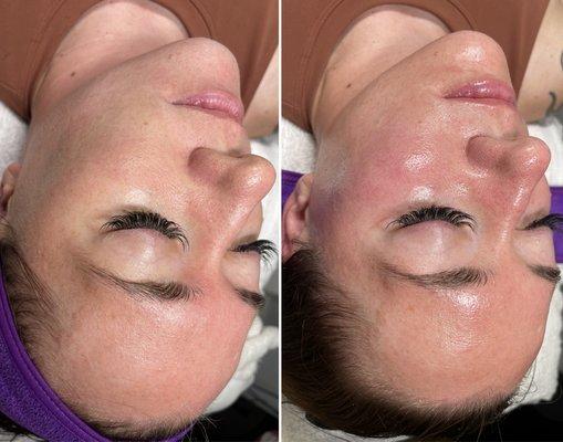 HydraFacial Glow