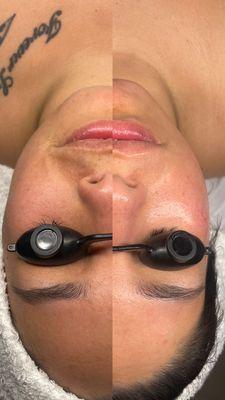 Before and after a Dermaplaning x's LeMeiux brightening facial.