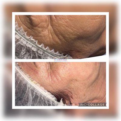 Anti wrinkle treatments