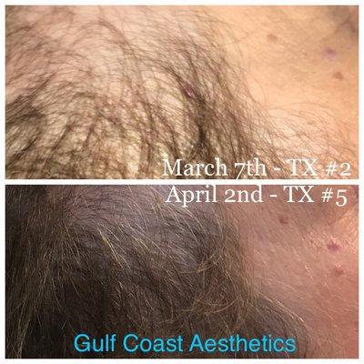 Hair restoration results from a woman experiencing advanced stages of hair
thinning. 6 treatments were performed in total.