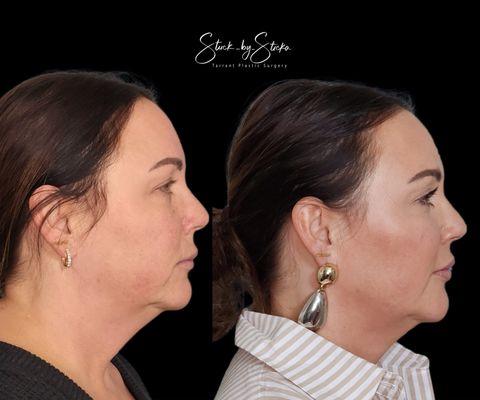 Full face rejuvenation with Botox and Juvederm Filler