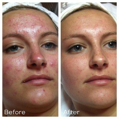 Microdermabrasion + Peel